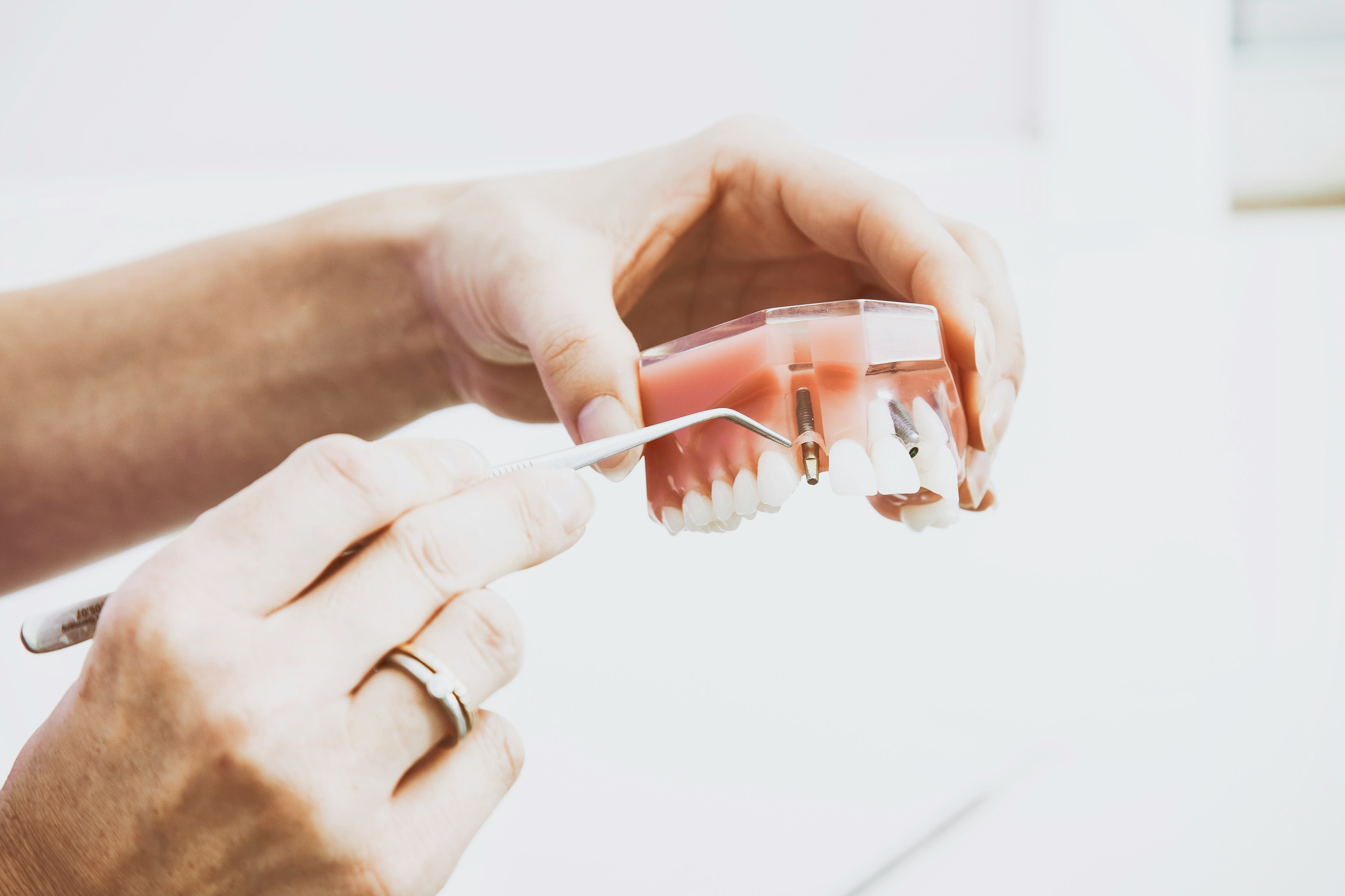 Implant dentar Dr. Badea Oradea
